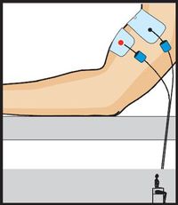 electroestimulacion COMPEX One entrenamiento musculatura rehabilitacion fuerza posicin electrodos marcar abdominales
