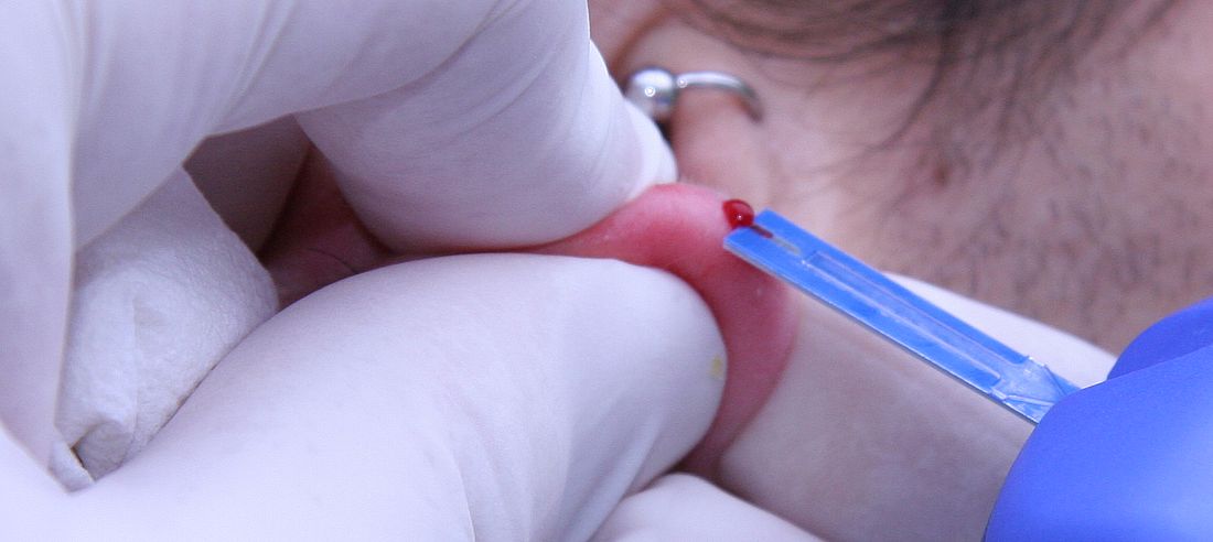 Toma de sangre del lóbulo de la oreja para el análisis de lactato sanguíneo con el analizador Lactate Scout