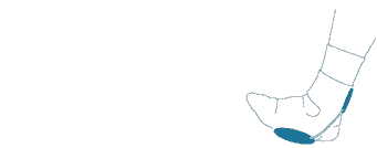 Imagen del funcionamiento de la Ortesis  producto ortopedia airheel tendinitis aquiles fascitis plantar