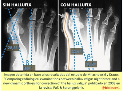 producto ortopedia hallux valgus juanete hallufix