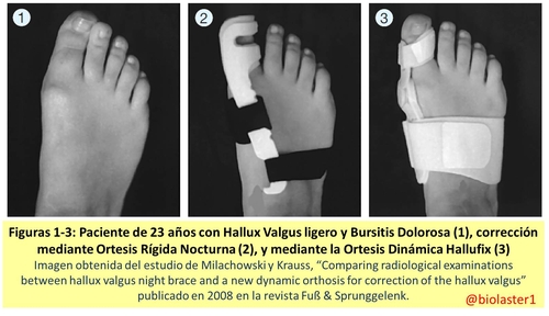 producto ortopedia hallux valgus juanete hallufix