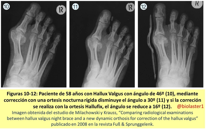 producto ortopedia hallux valgus juanete hallufix