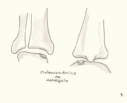 osteocondritis disecante tobillo astragalo traumatologia