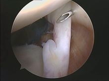 artroscopia hombro rotura parcial tendon bicipital