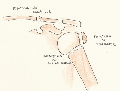 Tipos de fractura de hombro deporte