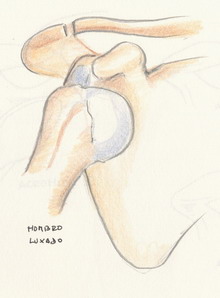 Luxacion hombro por rotura ligamentos