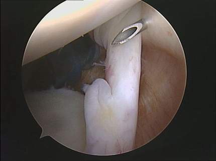 imagen artroscopia hombro con rotura parcial tendon biceps