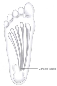 traumatologia pie lesiones arco plantar interno fascitis plantar