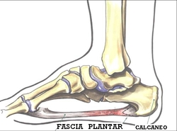 Fascitis Plantar. Biolaster