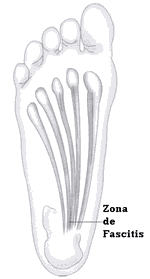 traumatologia pie lesiones arco plantar interno fascitis plantar