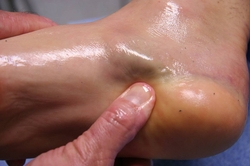 traumatologia pie lesiones arco plantar interno fascitis plantar