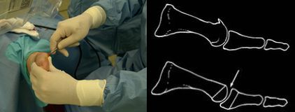 traumatologia pie lesiones arco plantar interno