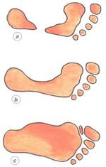 traumatologia pie lesiones arco plantar interno