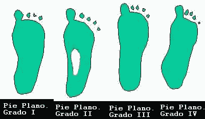 pie plano grados huella plantar podoscopio