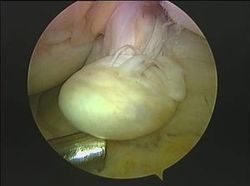  lesion rodilla rotura ligamento cruzado anterior