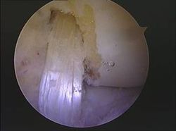 lesion rodilla rotura ligamento cruzado anterior plastia HTH