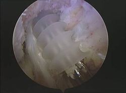 lesion rodilla rotura ligamento cruzado anterior plastia HTH