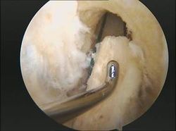 lesion rodilla rotura ligamento cruzado anterior plastia HTH