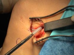 paciente plastia lemaire fijacion