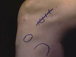 paciente plastia lemaire incision cutanea