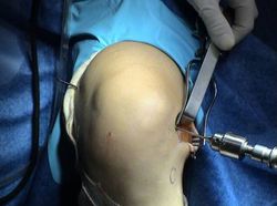 paciente plastia lemaire paso aguja
