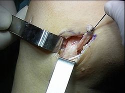 paciente plastia lemaire paso