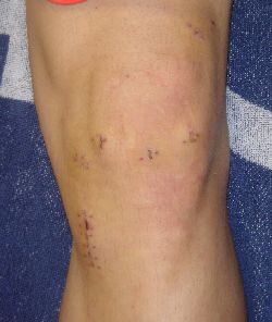 rodilla artroscopia ligamento cruzado anterior