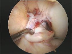 rotura ligamento cruzado anterior rodilla artroscopia