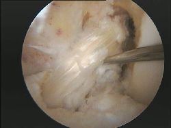 plastia intervencion rotura ligamento cruzado anterior rodilla LCA