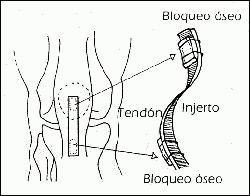 esquema plastia HTH sustitucion ligamento cruzado anterior rodilla LCA