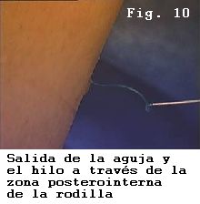 rodilla asa de cubo menisco interno