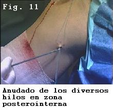 rodilla asa de cubo menisco interno