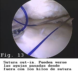 rodilla sutura menisco material