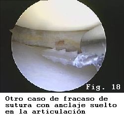 rodilla rotura menisco sutura