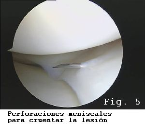 rodilla asa de cubo menisco interno