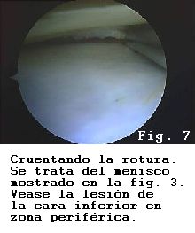 rodilla rotura menisco sutura