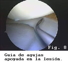 rodilla lesion rotura menisco sutura