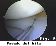 rodilla lesion rotura menisco sutura