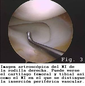 rodilla menisco interno vascularizacion periferica