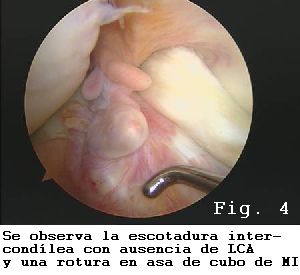 rodilla asa de cubo menisco interno