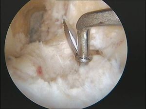 tecnica quirurgica cirugia inestabilidad rodilla ligamento cruzado anterior LCA