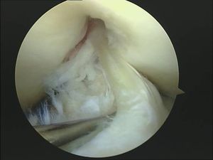 tecnica quirurgica cirugia inestabilidad rodilla ligamento cruzado anterior LCA