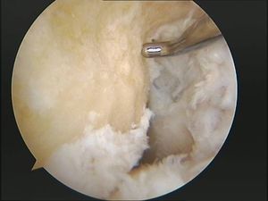 tecnica quirurgica cirugia  inestabilidad rodilla ligamento cruzado anterior LCA