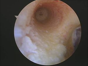 tecnica quirurgica cirugia  inestabilidad rodilla ligamento cruzado anterior LCA