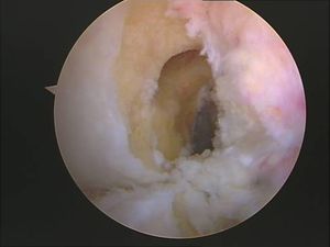 tecnica quirurgica cirugia  inestabilidad rodilla ligamento cruzado anterior LCA