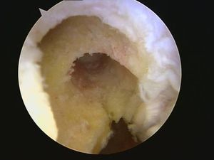 tecnica quirurgica cirugia  inestabilidad rodilla ligamento cruzado anterior LCA