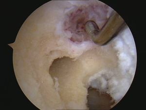 tecnica quirurgica cirugia  inestabilidad rodilla ligamento cruzado anterior LCA