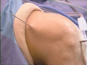 tecnica quirurgica cirugia inestabilidad rodilla ligamento cruzado anterior LCA