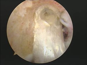 tecnica quirurgica cirugia  inestabilidad rodilla ligamento cruzado anterior LCA