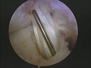 tecnica quirurgica cirugia  inestabilidad rodilla ligamento cruzado anterior LCA